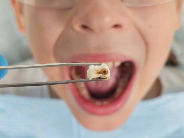 Best Emergency Tooth Extraction in Fairview, MT